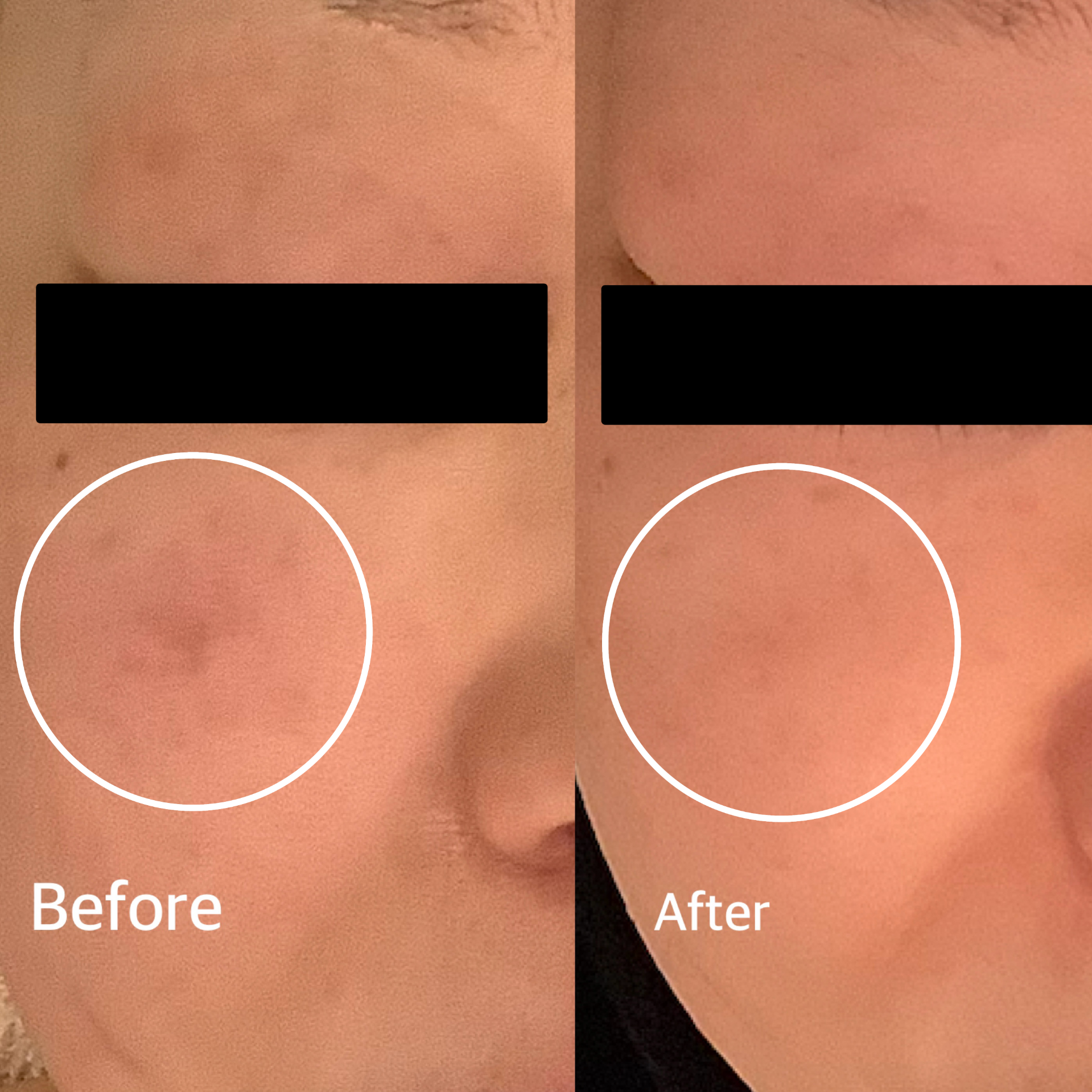 広島エステ　シミシワ取り